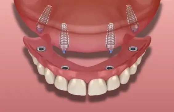 Fixed Full-Arch Restorations