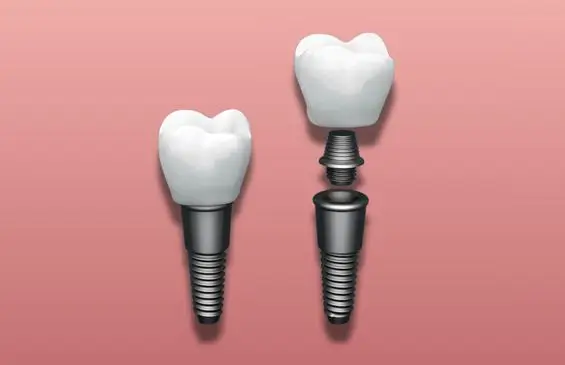 Dental Implant Visualization