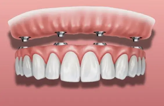 Snap On Dentures