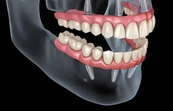 Porcelain Restorations