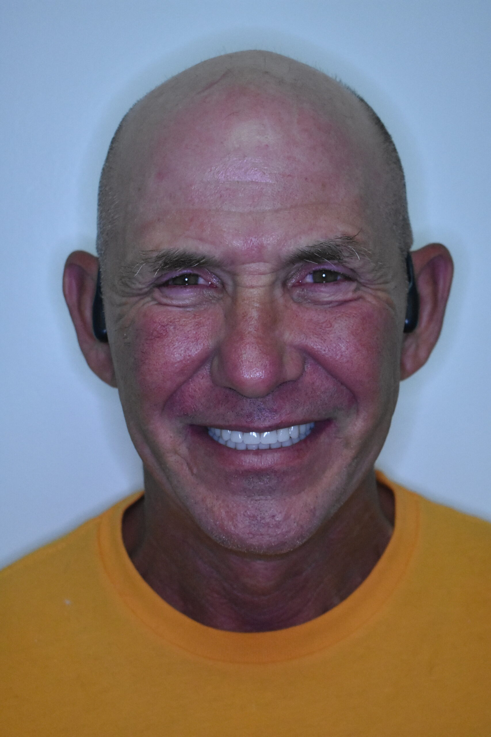 After treatment, Cura Smiles patient case 5
