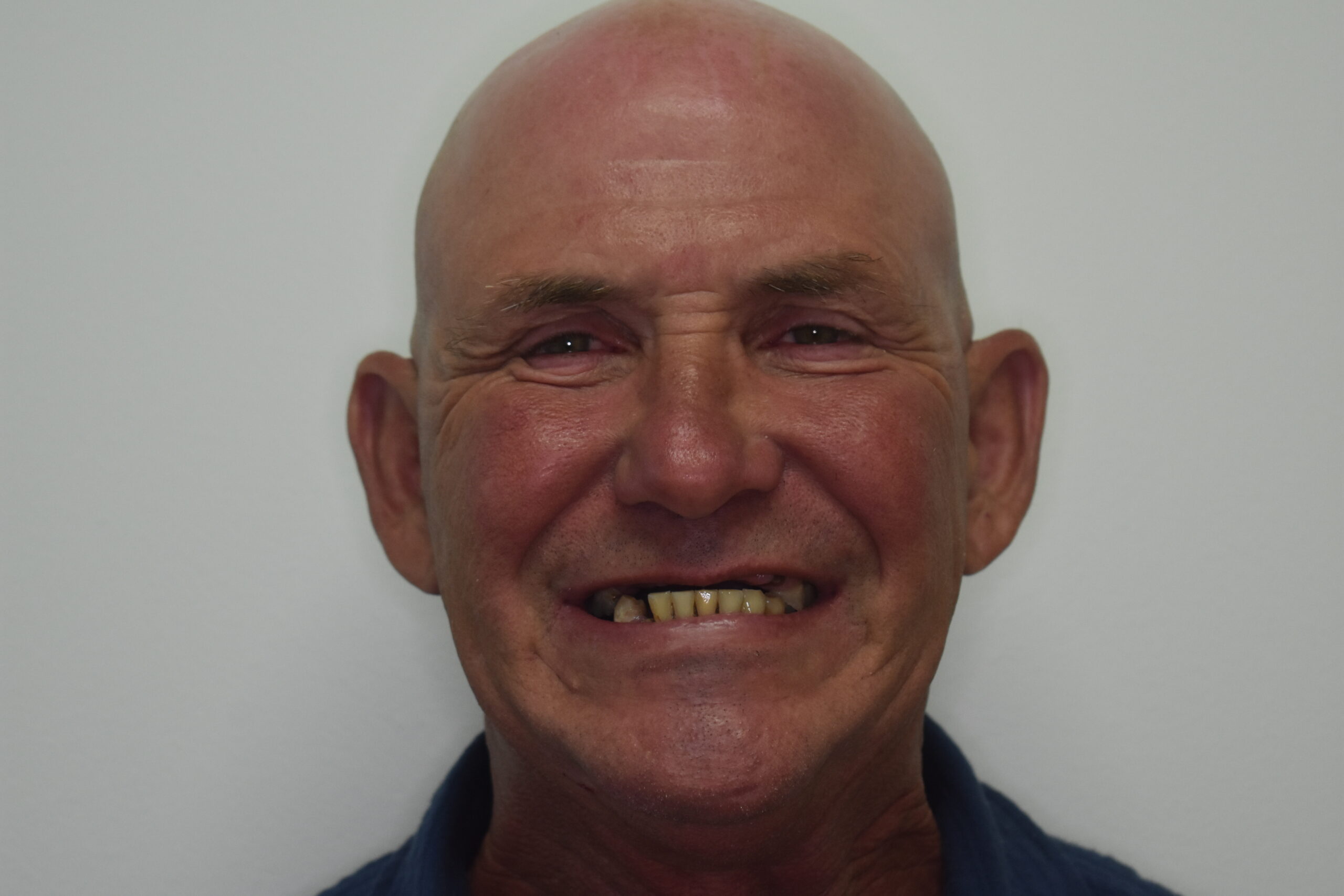 Before treatment, Cura Smiles patient case 5
