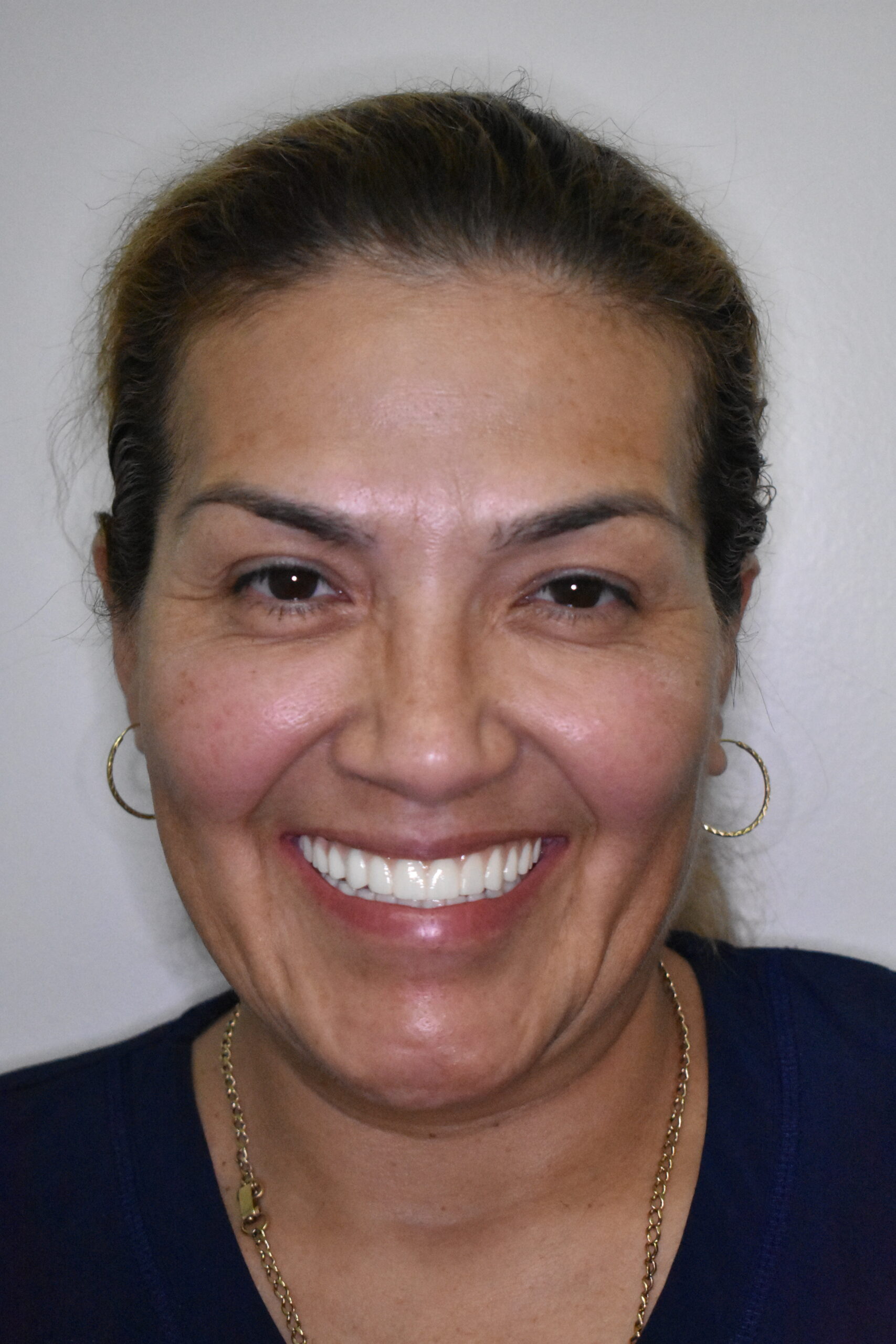 After treatment, Cura Smiles patient case 4