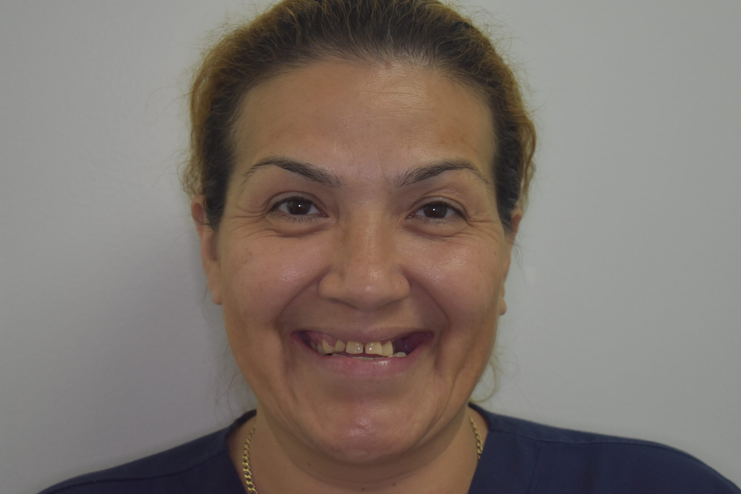 Before treatment, Cura Smiles patient case 4
