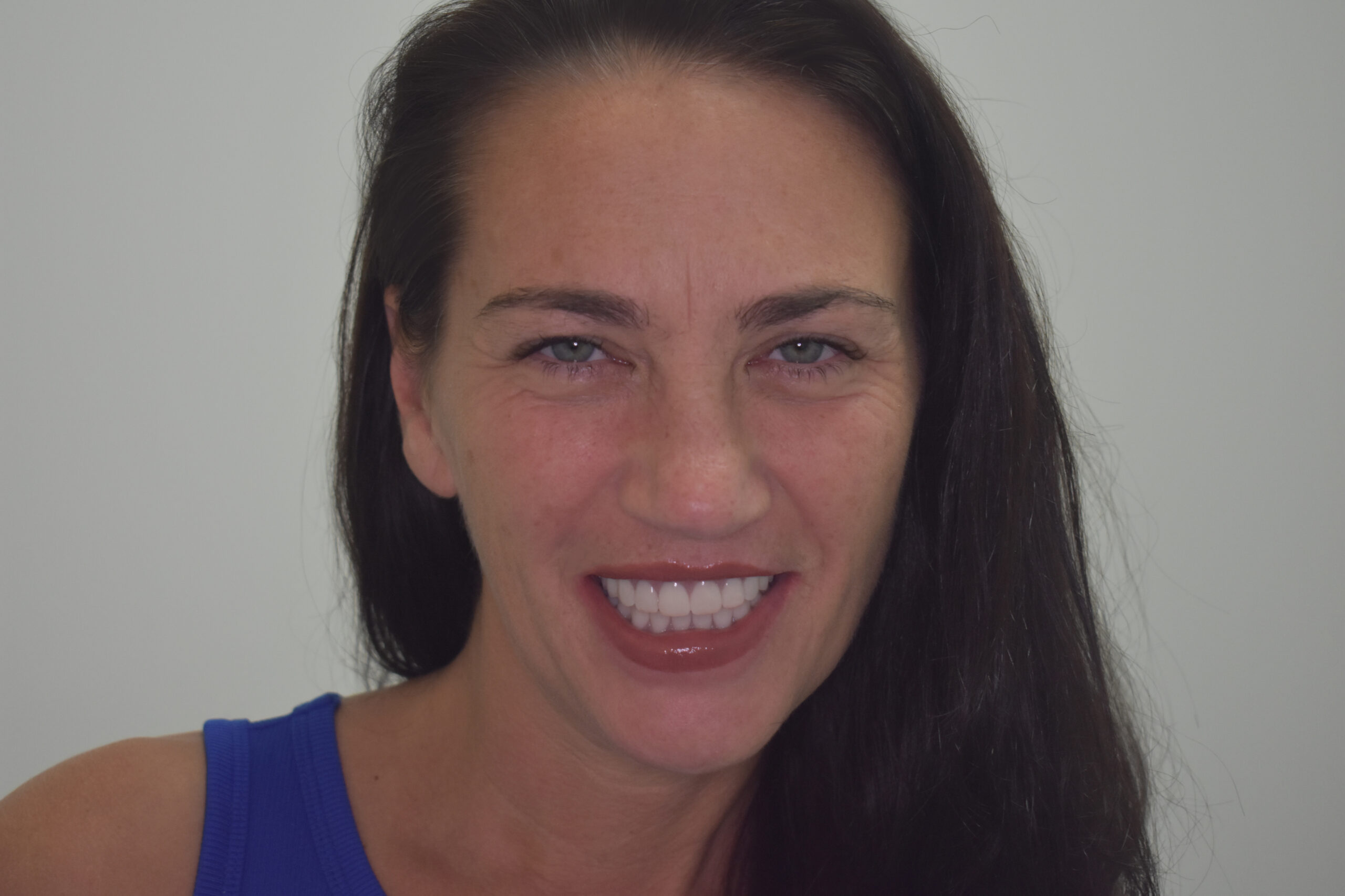 After treatment, Cura Smiles patient case 3