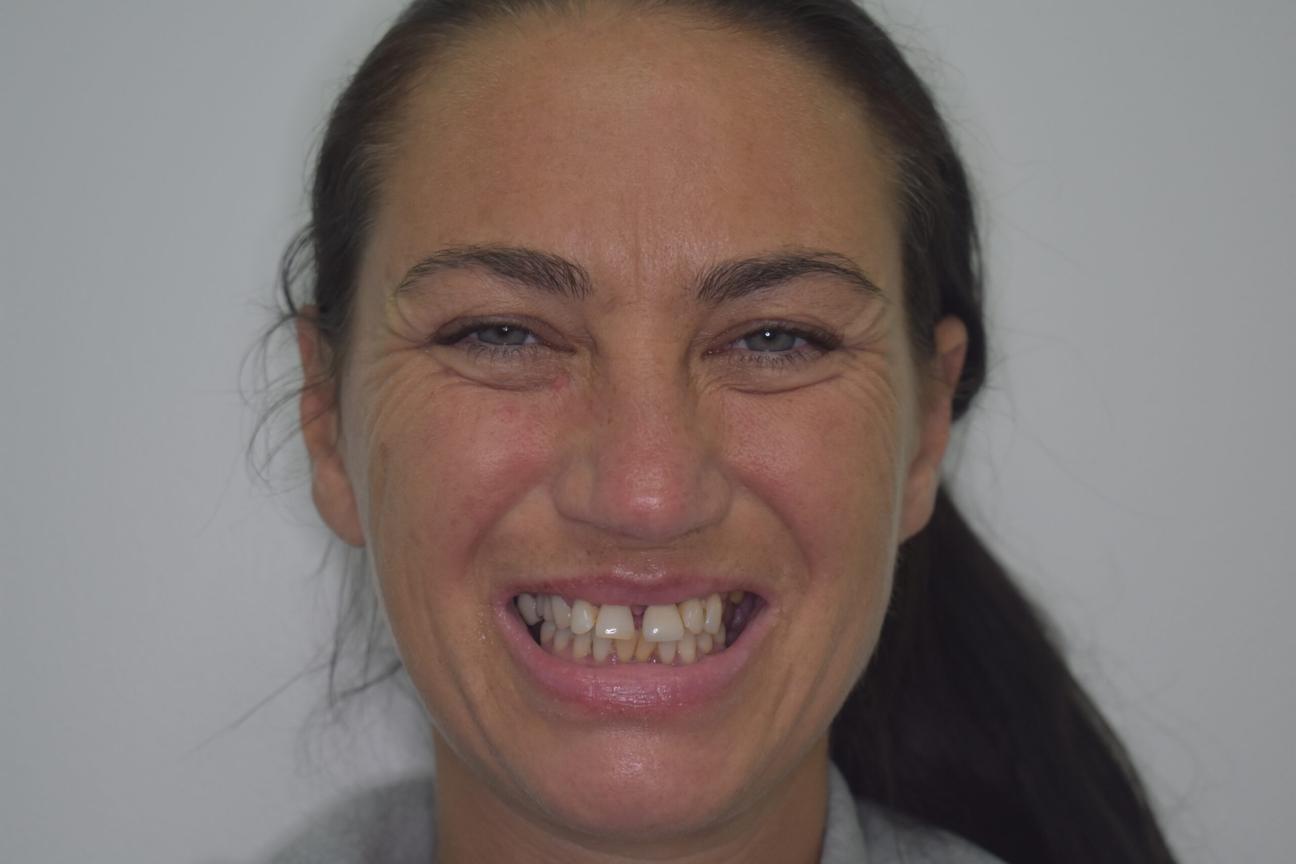 Before treatment, Cura Smiles patient case 3
