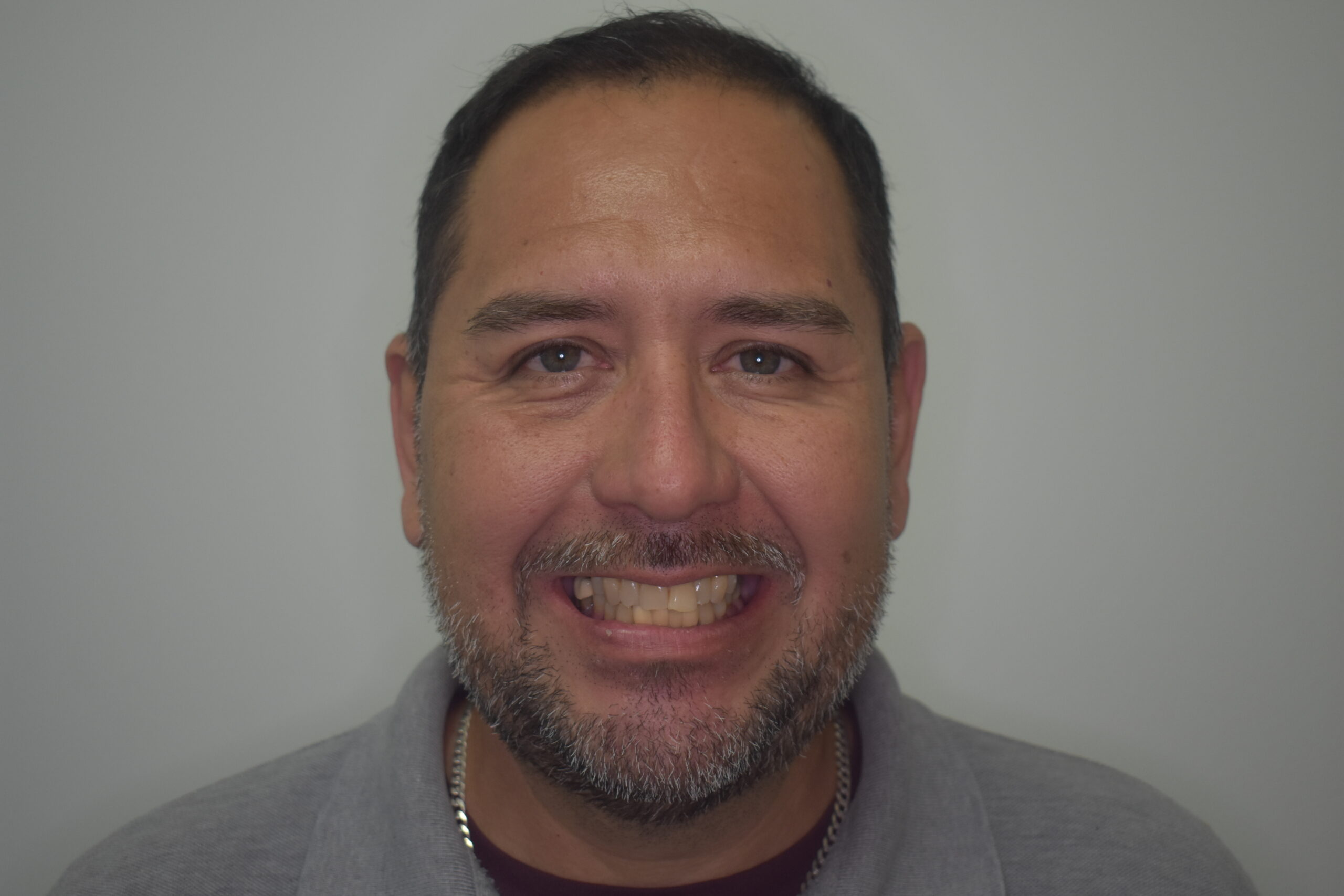 Before treatment, Cura Smiles patient case 2