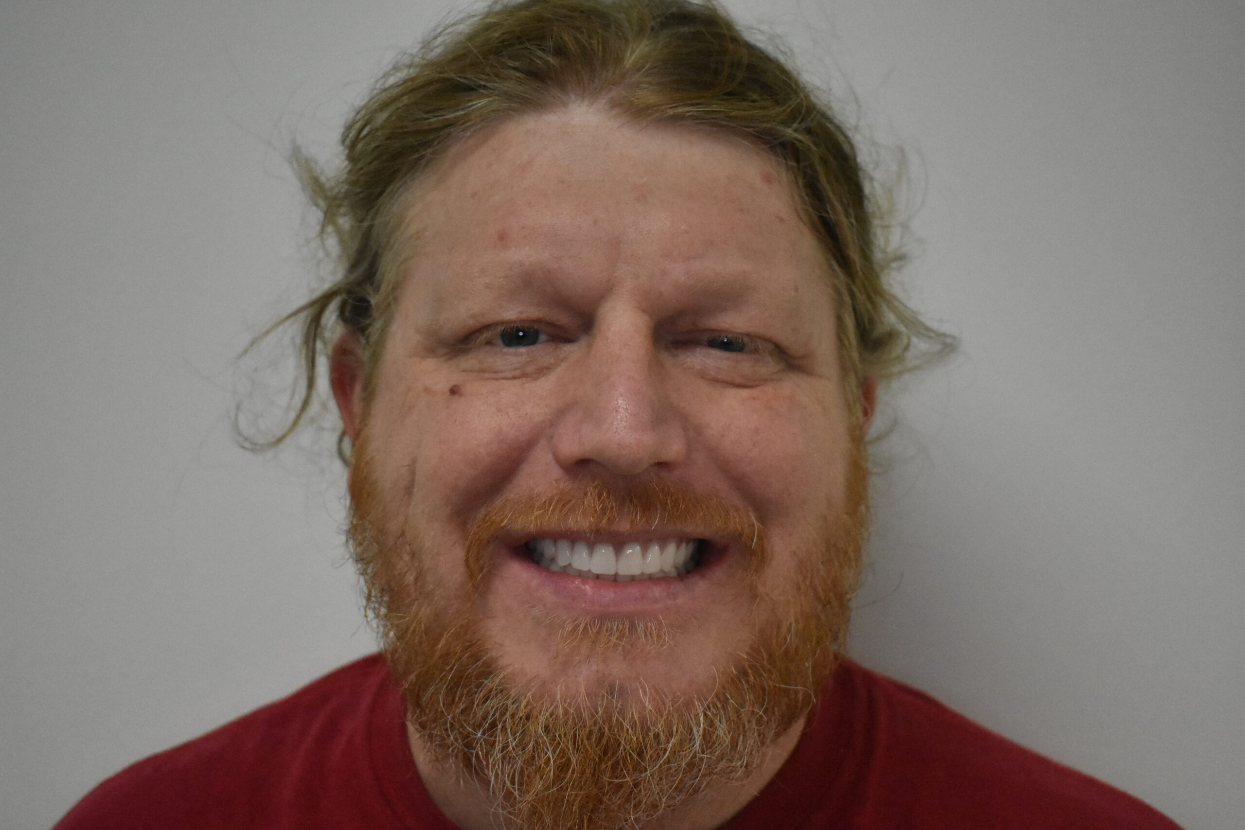 After treatment, Cura Smiles patient case 1