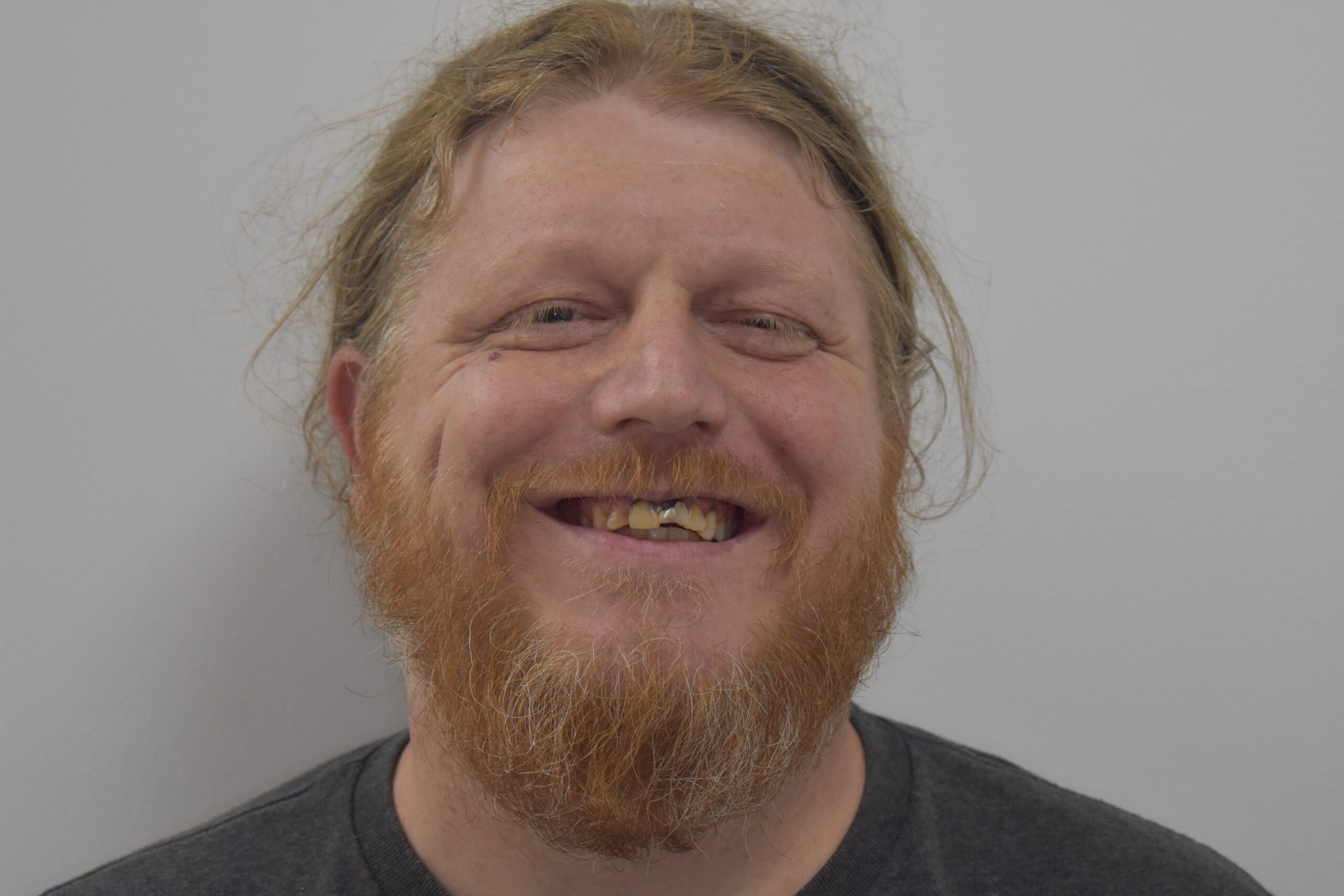 Before treatment, Cura Smiles patient case 1